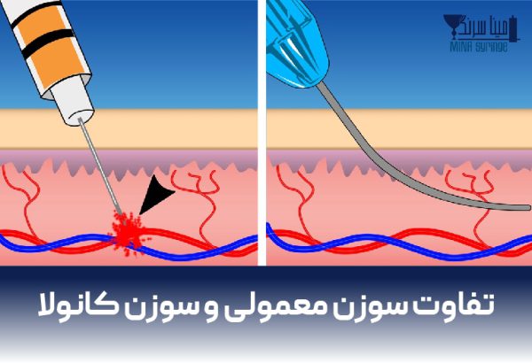 تفاوت سوزن معمولی و سوزن کانولا