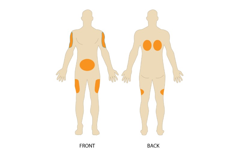 محل های تزریق زیر جلدی