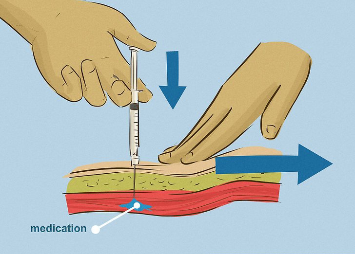 روش دقیق تزریق عضلانی
