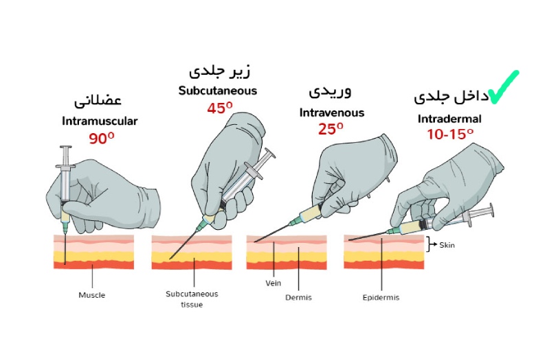 تزریق داخل جلدی چیست؟