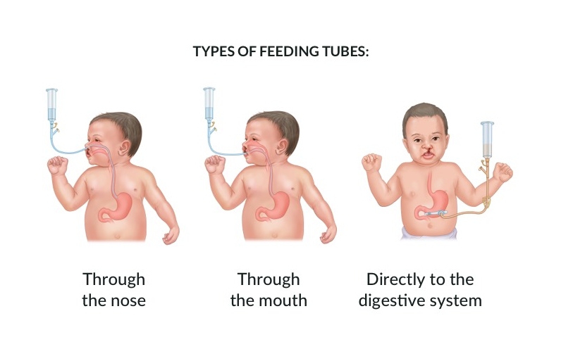 انواع روش های گاواژ