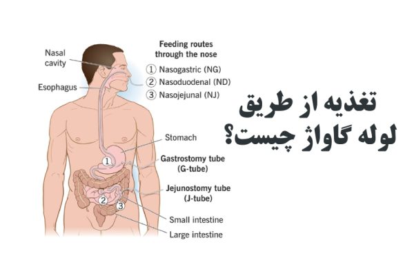تغذیه از طریق لوله یا گاواژ چیست؟