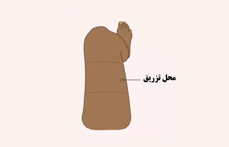 محل درست تزریق عضلانی اپی نفرین