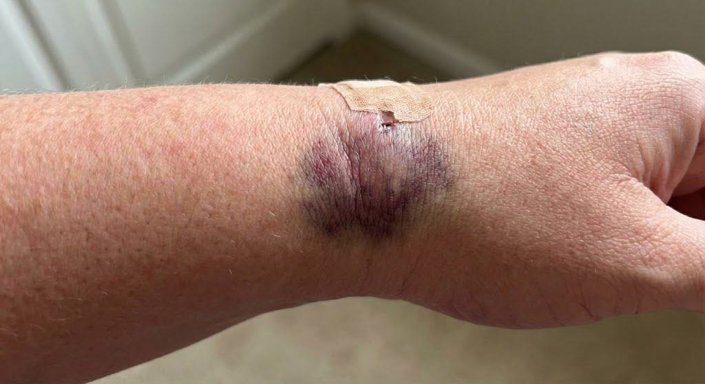 عکس پاره شدن رگ دست