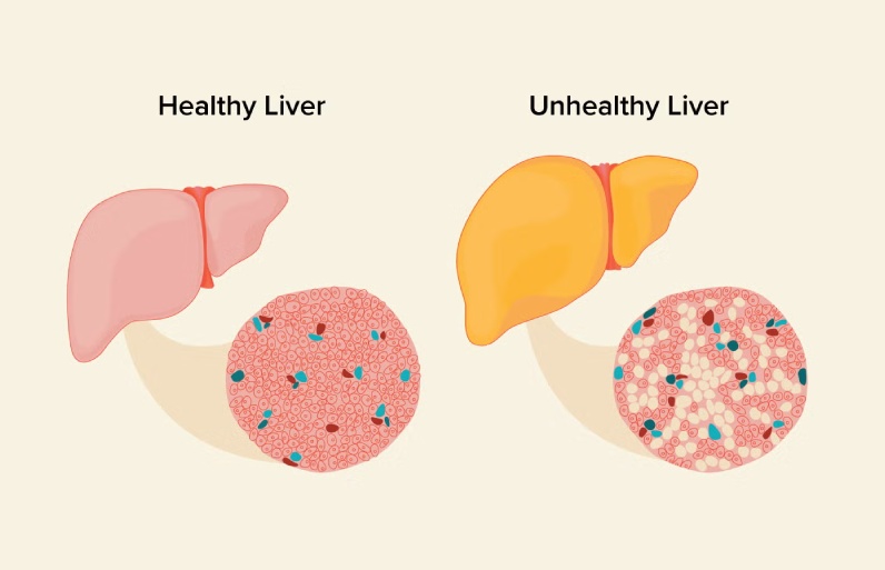 علت بالا رفتن آنزیم‌های کبدی