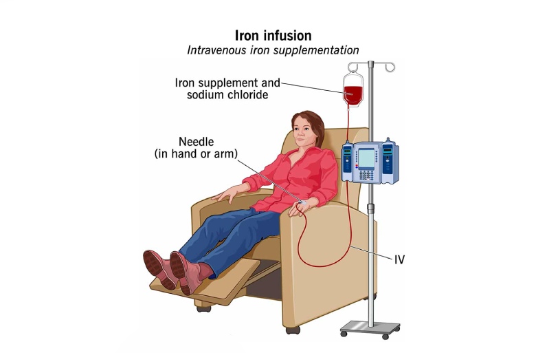 تزریق سرم آهن