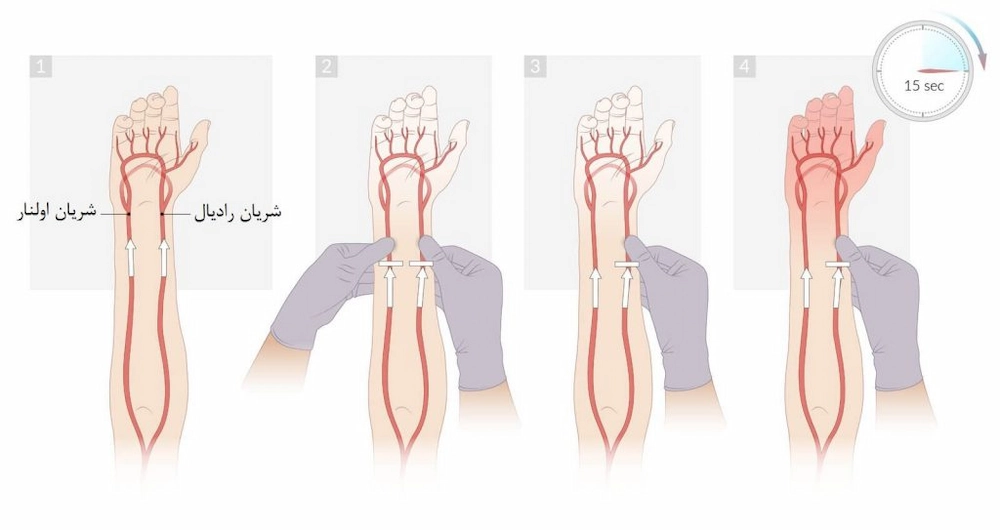 انواع خونگیری شریانی