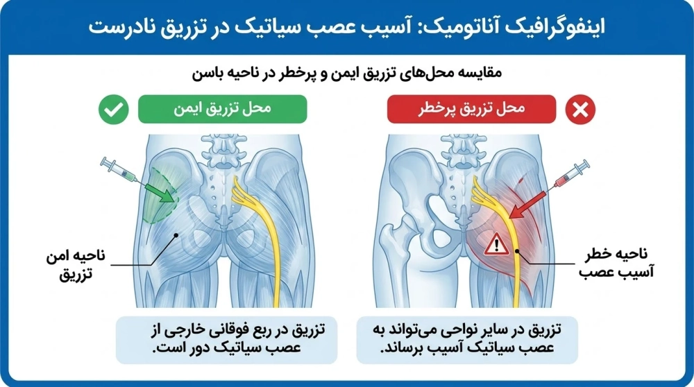 آسیب به عصب سیاتیک بعد از تزریق