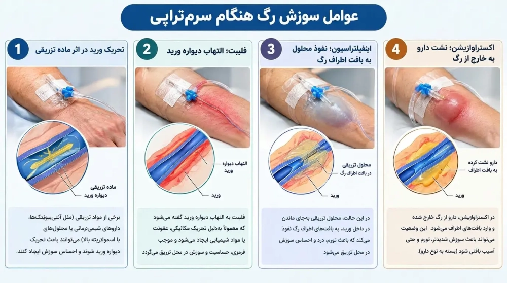 عوامل سوزش رگ هنگام سرم تراپی
